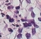 Leukocytoclastische vasculitis
