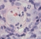 Leukocytoclastische vasculitis