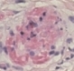 Leukocytoclastische vasculitis