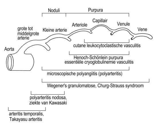 Classification of vasculitis based on vessel size