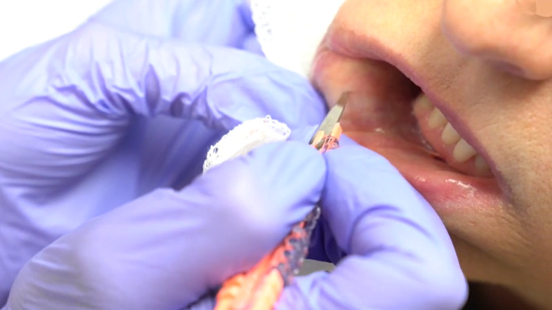 Biopt speekselklier Sjögren