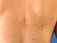 flagellate erythema als bijwerking van bleomycine