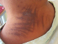 flagellate erythema als bijwerking van bleomycine