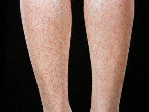 Hyperkeratosis lenticularis perstans (Flegel)