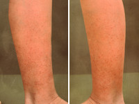 Hyperkeratosis lenticularis perstans (Flegel)