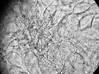 Candia vaginitis (KOH)