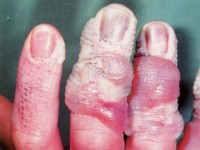 Fluorwaterstof chemische verbranding