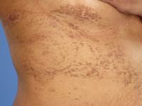 Focale dermale hypoplasie (Goltz syndroom)