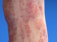 Focale dermale hypoplasie (Goltz syndroom)