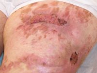 Focale dermale hypoplasie (Goltz syndroom)