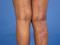 Focale dermale hypoplasie (Goltz syndroom)