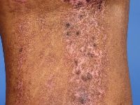 Focale dermale hypoplasie (Goltz syndroom)