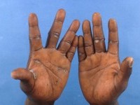 Focale acrale keratose, keratosis punctata of the palmar creases