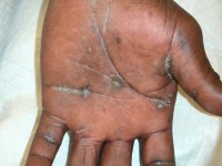 Focale acrale keratose, keratosis punctata of the palmar creases