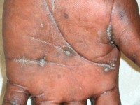 Focale acrale keratose, keratosis punctata of the palmar creases