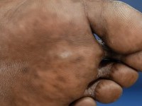 Focale acrale keratose, keratosis punctata of the palmar creases