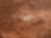 Focale acrale keratose, keratosis punctata of the palmar creases