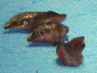 Focale acrale keratose, keratosis punctata of the palmar creases