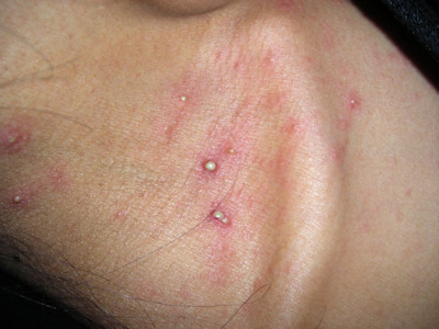 Folliculitis