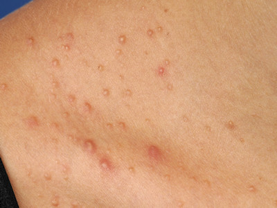 Folliculitis