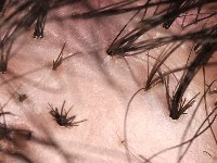 Folliculitis decalvans