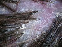 Folliculitis decalvans