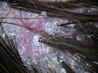 Folliculitis decalvans