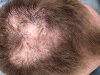 Folliculitis decalvans