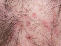 Folliculitis decalvans