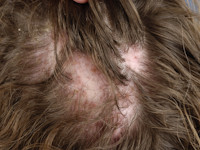 Folliculitis decalvans