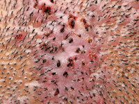 Folliculitis decalvans