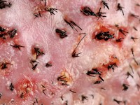 Folliculitis decalvans