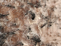 Folliculitis decalvans