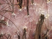 Folliculitis decalvans