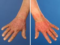 Fototoxische reactie