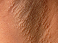 Ziekte van Fox-Fordyce