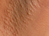 Ziekte van Fox-Fordyce