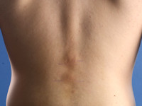 Lichenoide frictie dermatitis