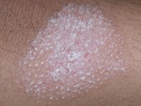 Lichenoide frictie dermatitis