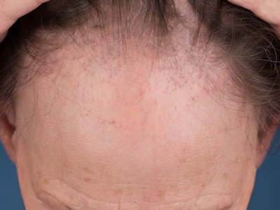 frontal fibrosing alopecia