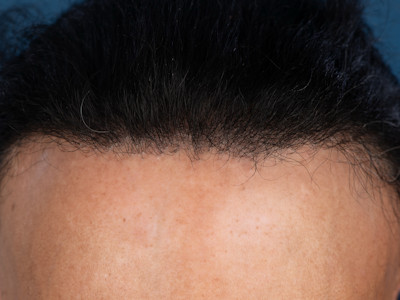 Frontal fibrosing alopecia