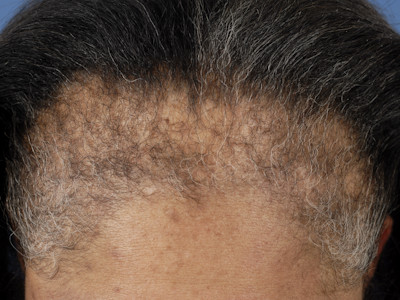 Frontal fibrosing alopecia