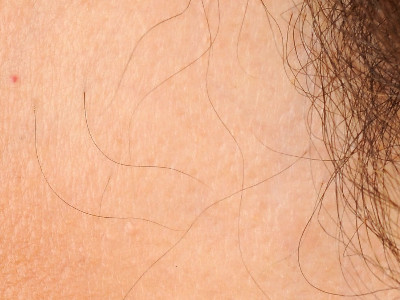 Frontal fibrosing alopecia
