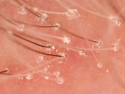 Frontal fibrosing alopecia