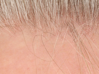 Frontal fibrosing alopecia