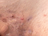 Staphylococcus lugdunensis