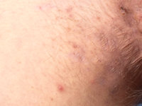 Staphylococcus lugdunensis