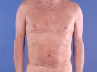 Generalized eruptive histiocytoma