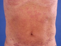 Generalized eruptive histiocytoma