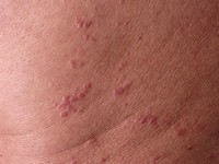 Generalized eruptive histiocytoma